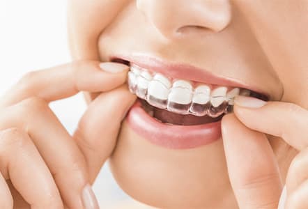 Invisalign | Cornerstone Dentistry | Brantford Dentist